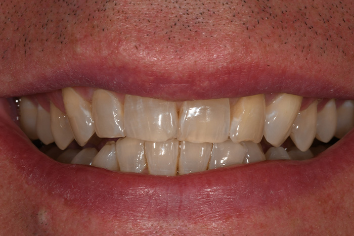 Before After Dental Photos Before and After | BayView Dental Arts