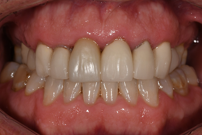 Before After Dental Photos Before and After | BayView Dental Arts