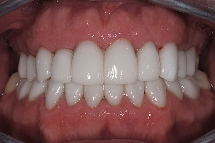 Before After Dental Photos Before and After | BayView Dental Arts