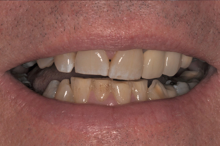 Before After Dental Photos Before and After | BayView Dental Arts