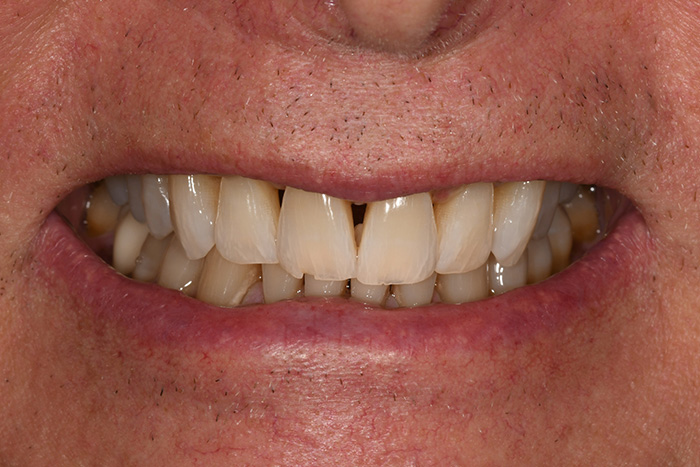 Before After Dental Photos Before and After | BayView Dental Arts