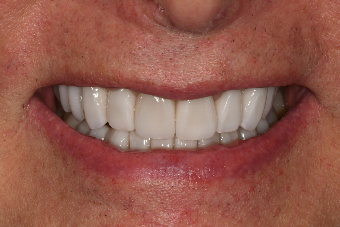 Before After Dental Photos Before and After | BayView Dental Arts