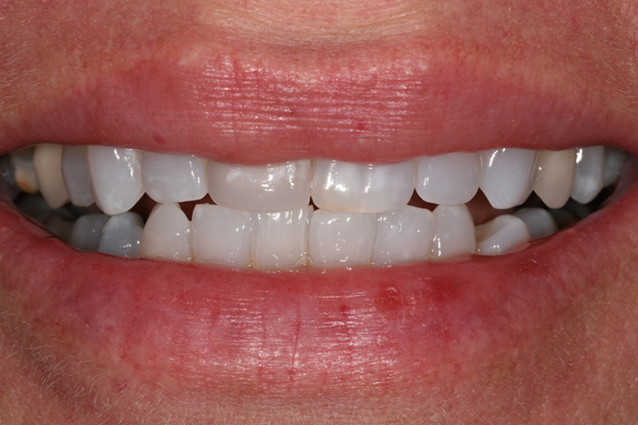 Before After Dental Photos Before and After | BayView Dental Arts