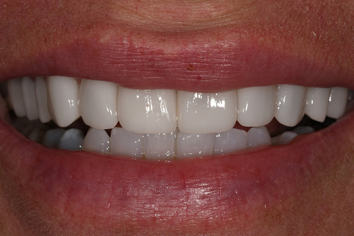 Before After Dental Photos Before and After | BayView Dental Arts