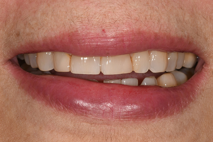 Before After Dental Photos Before and After | BayView Dental Arts