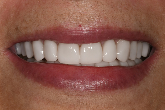 Before After Dental Photos Before and After | BayView Dental Arts