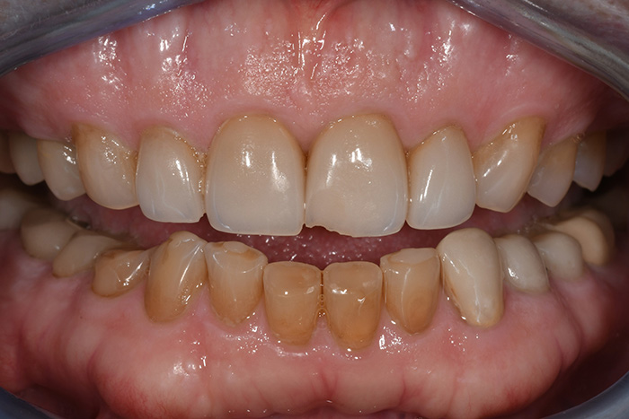 Before After Dental Photos Before and After | BayView Dental Arts