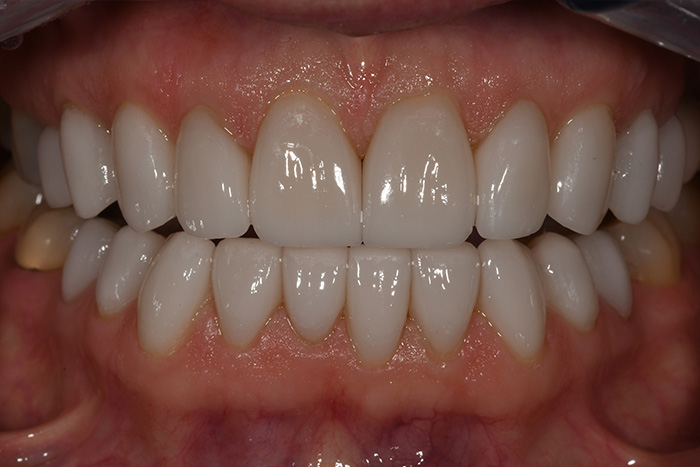 Before After Dental Photos Before and After | BayView Dental Arts