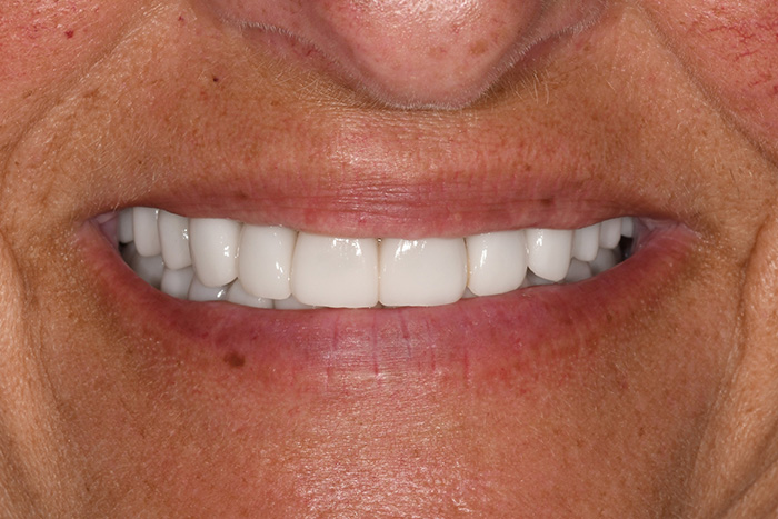 Before After Dental Photos Before and After | BayView Dental Arts