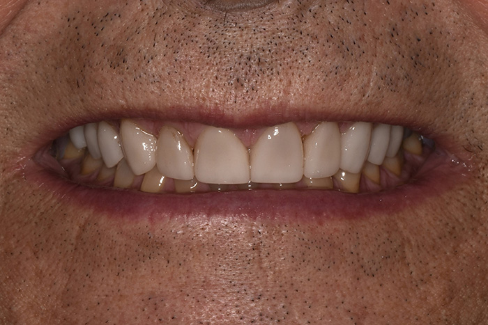 Before After Dental Photos Before and After | BayView Dental Arts