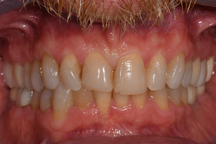 Before After Dental Photos Before and After | BayView Dental Arts