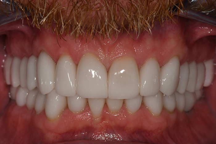 Before After Dental Photos Before and After | BayView Dental Arts