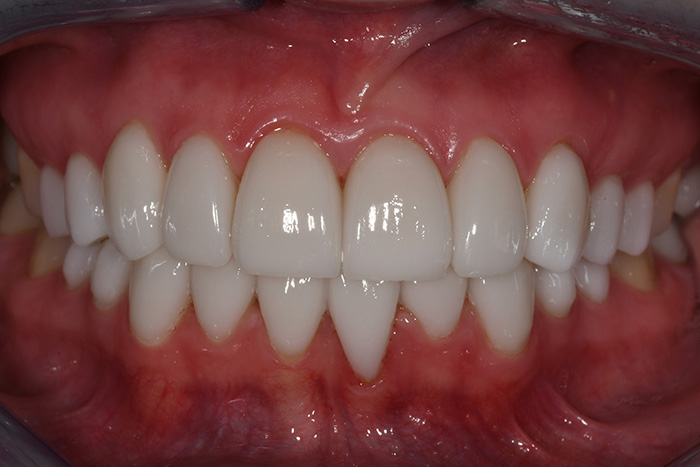 Before After Dental Photos Before and After | BayView Dental Arts