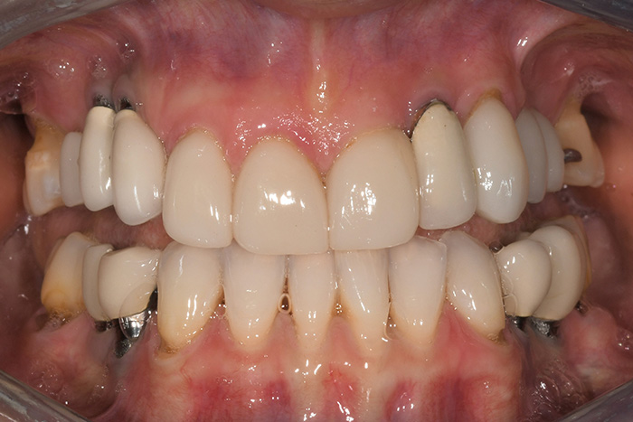 Before After Dental Photos Before and After | BayView Dental Arts