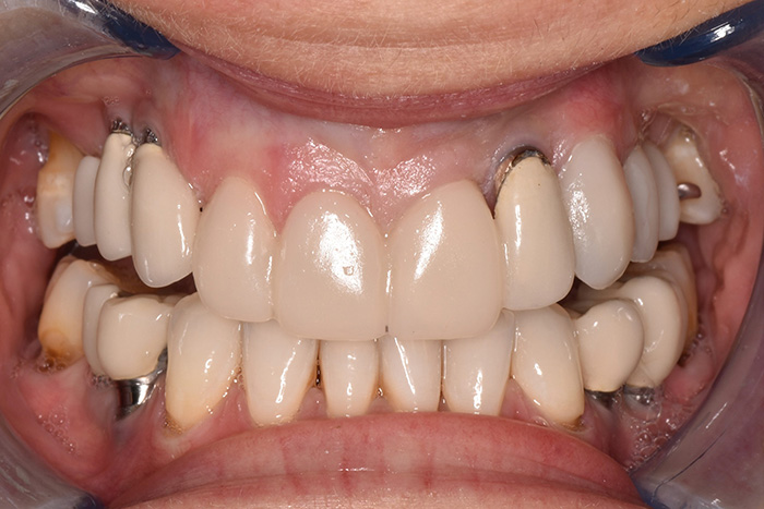 Before After Dental Photos Before and After | BayView Dental Arts