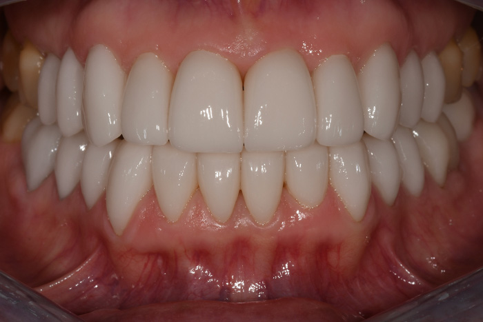 Before After Dental Photos Before and After | BayView Dental Arts