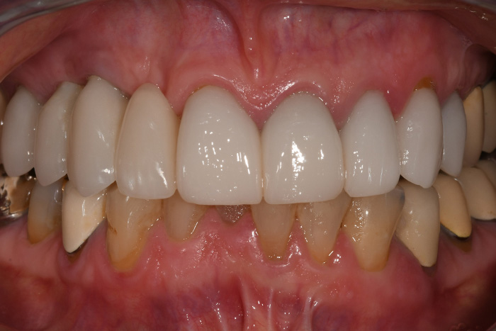 Before After Dental Photos Before and After | BayView Dental Arts