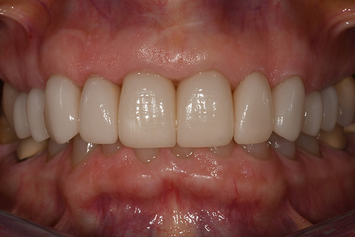 Before After Dental Photos Before and After | BayView Dental Arts