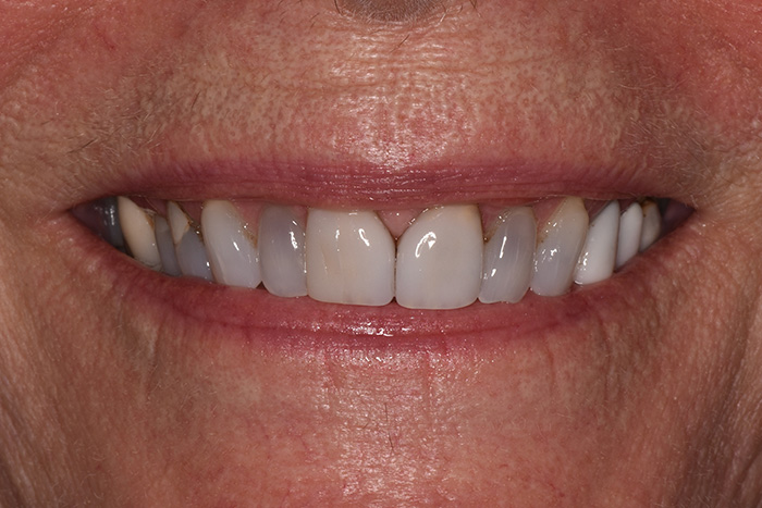 Before After Dental Photos Before and After | BayView Dental Arts