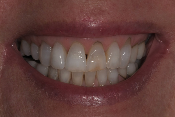 Before After Dental Photos Before and After | BayView Dental Arts