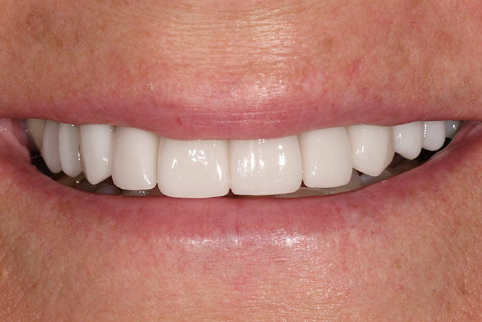 Before After Dental Photos Before and After | BayView Dental Arts