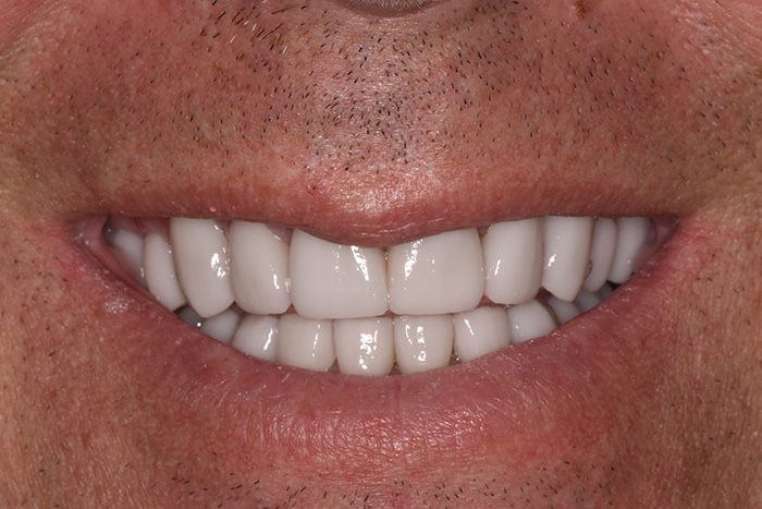 Before After Dental Photos Before and After | BayView Dental Arts