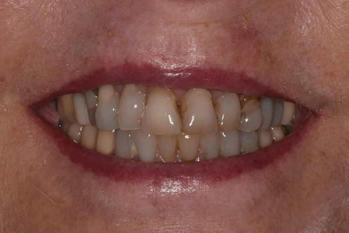 Before After Dental Photos Before and After | BayView Dental Arts