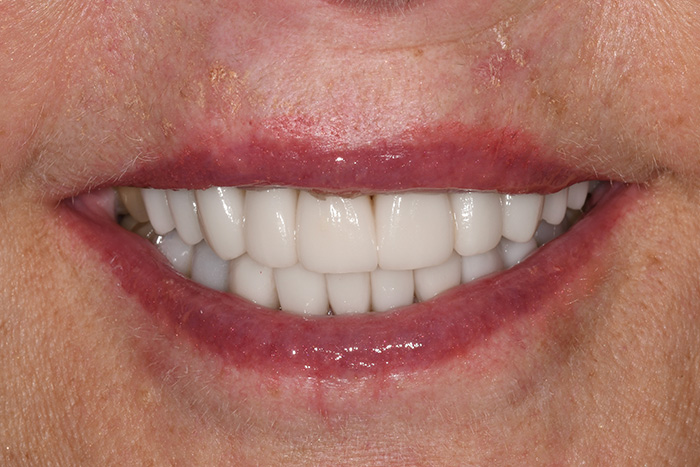 Before After Dental Photos Before and After | BayView Dental Arts