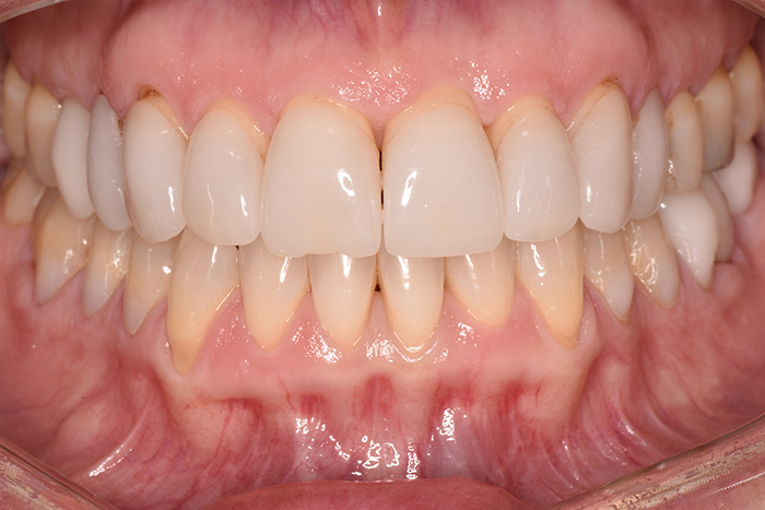 Before After Dental Photos Before and After | BayView Dental Arts