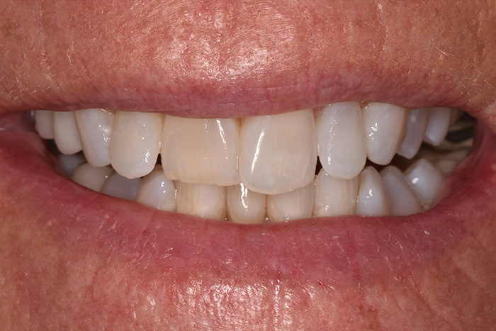 Before After Dental Photos Before and After | BayView Dental Arts