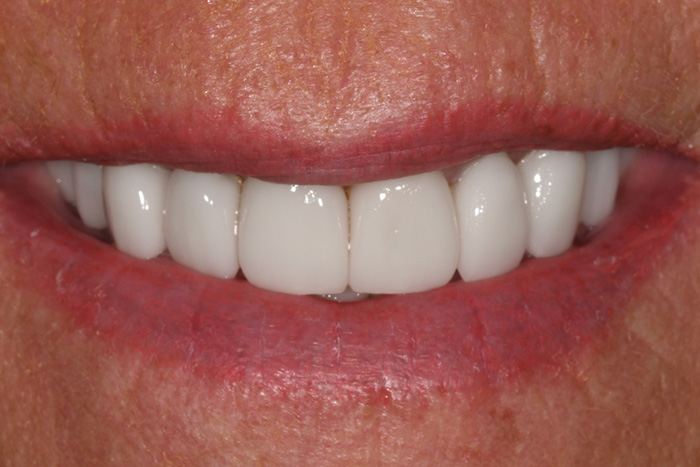 Before After Dental Photos Before and After | BayView Dental Arts