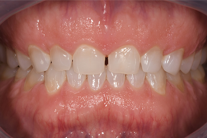 Before After Dental Photos Before and After | BayView Dental Arts