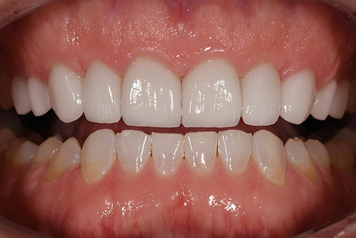 Before After Dental Photos Before and After | BayView Dental Arts