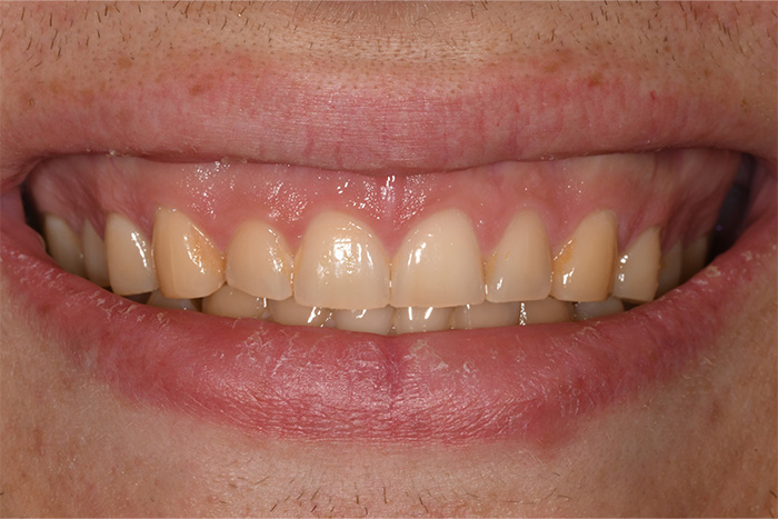 Before After Dental Photos Before and After | BayView Dental Arts