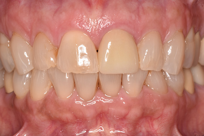 Before After Dental Photos Before and After | BayView Dental Arts