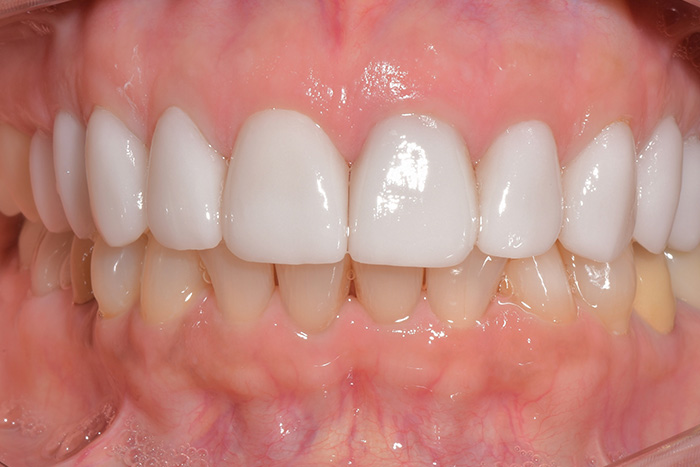 Before After Dental Photos Before and After | BayView Dental Arts