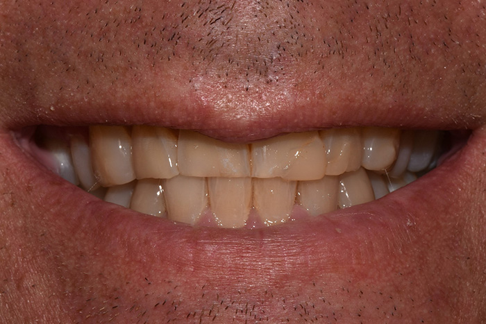 Before After Dental Photos Before and After | BayView Dental Arts