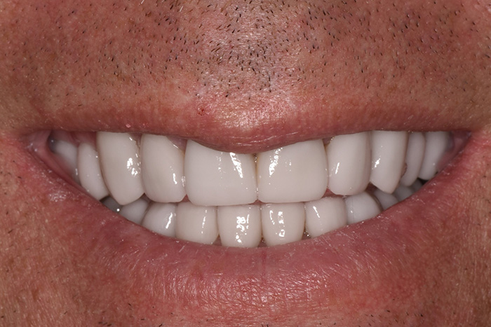 Before After Dental Photos Before and After | BayView Dental Arts