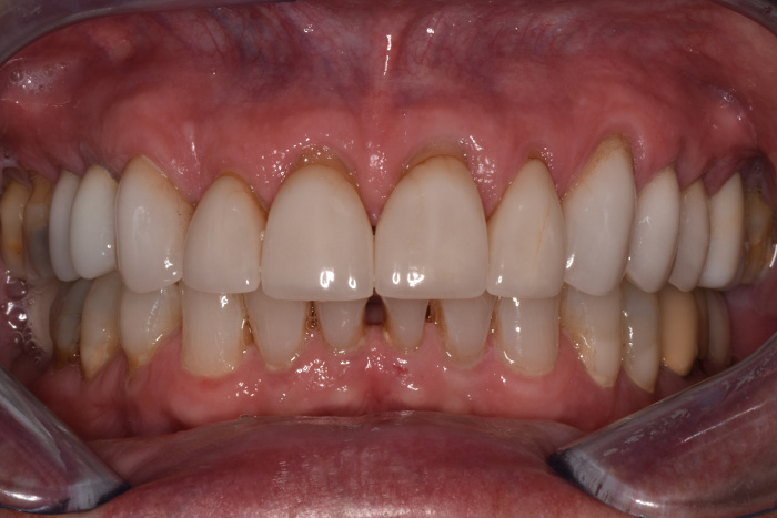 Before After Dental Photos Before and After | BayView Dental Arts