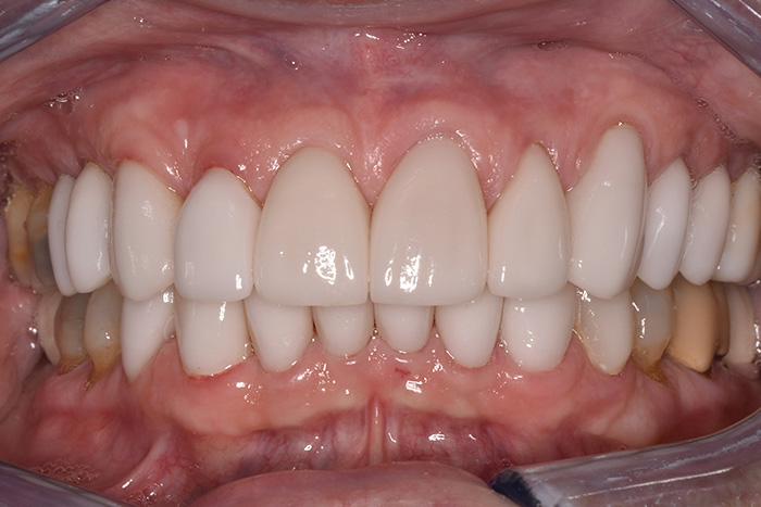 Before After Dental Photos Before and After | BayView Dental Arts