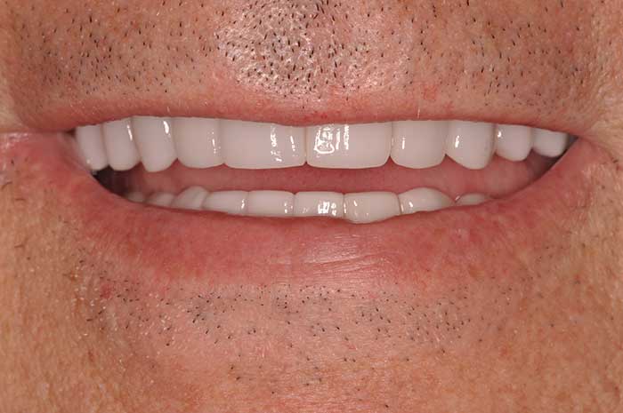 Before After Dental Photos Before and After | BayView Dental Arts