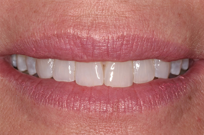 Before After Dental Photos Before and After | BayView Dental Arts