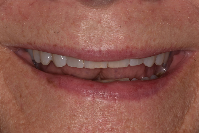 Before After Dental Photos Before and After | BayView Dental Arts