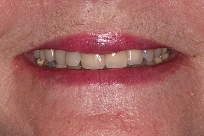 Before After Dental Photos Before and After | BayView Dental Arts