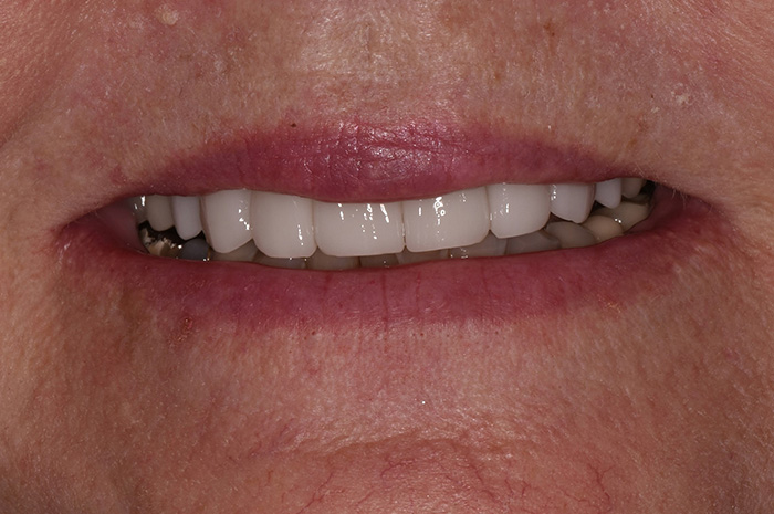 Before After Dental Photos Before and After | BayView Dental Arts