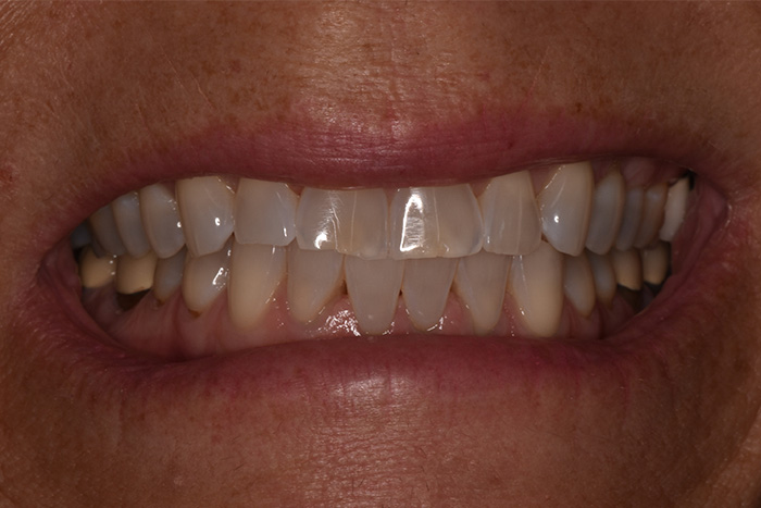 Before After Dental Photos Before and After | BayView Dental Arts