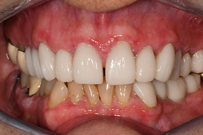 Before After Dental Photos Before and After | BayView Dental Arts