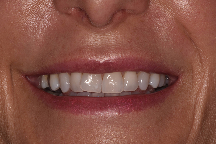 Before After Dental Photos Before and After | BayView Dental Arts