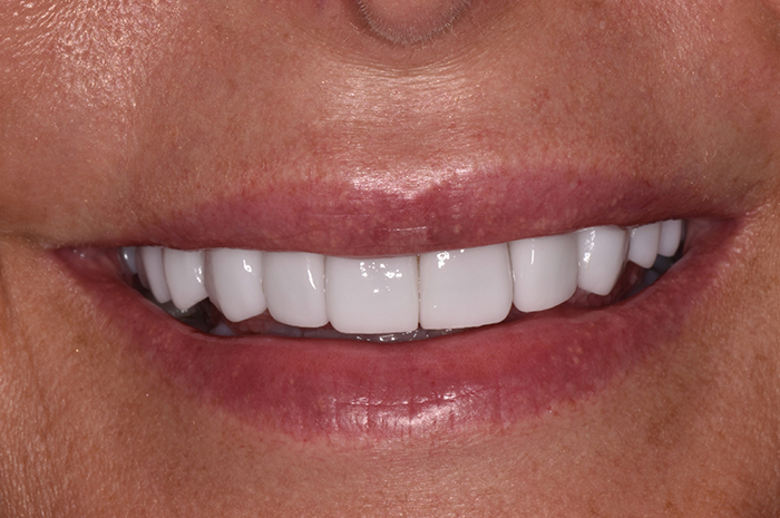 Before After Dental Photos Before and After | BayView Dental Arts