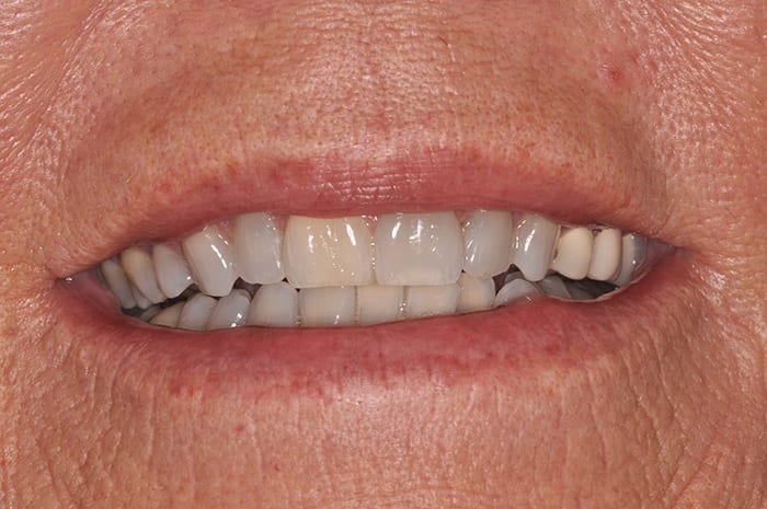 Before After Dental Photos Before and After | BayView Dental Arts